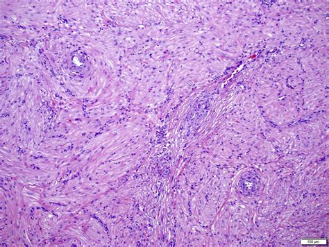 Pathology Outlines Angioleiomyoma