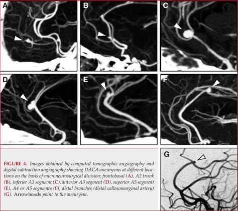 Figure 4 From Anatomic Features Of Distal Anterior Cerebral Artery Aneurysms A Detailed