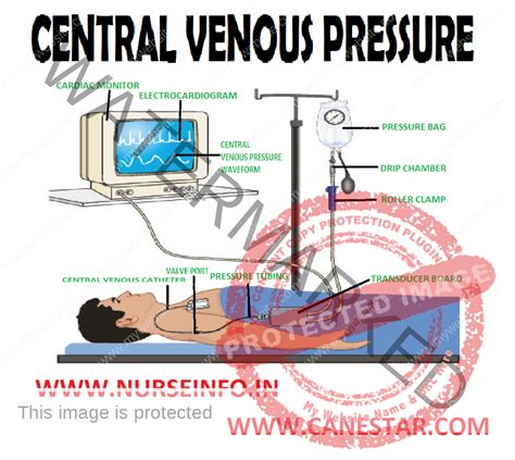 Ppt Central Venous Line Cvl And Central Venous Pressure Off