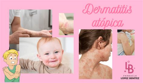 Dermatitis At Pica Farmacia L Pez Ben Tez