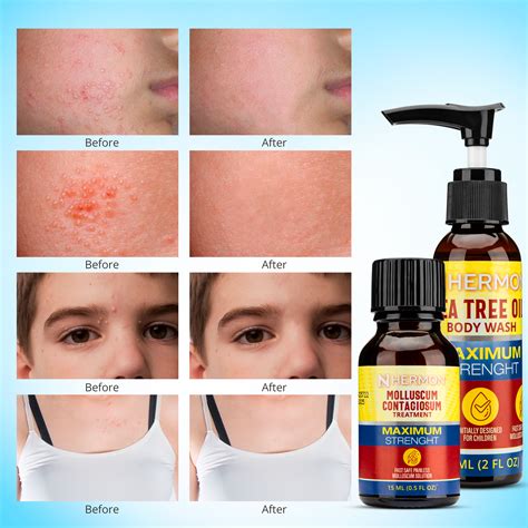 Molluscum Contagiosum Treatment15ml Molluscum Cream With Tea Tree Oil Formulation For Adults