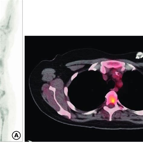 Pdf Ipsilateral Malignant Axillary Lymphadenopathy And Contralateral Reactive Lymph Nodes In A