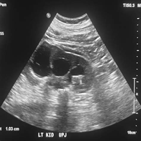 Pdf Acute Bilateral Ureteropelvic Junction Obstruction As A Rare Cause Of Hypertensive Crisis