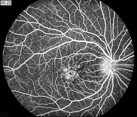 Fluorescein Angiography Of Stargardt S Disease A K A Juvenile Macular Degeneration Fundus