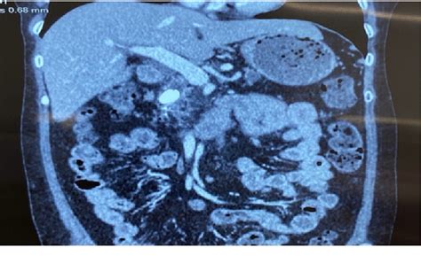 Figure From Laparoscopic Pancreatic Duct Exploration