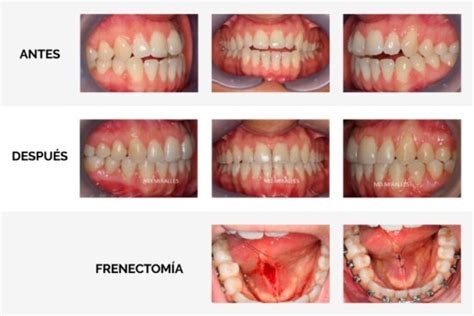 Cu Ndo Operar El Frenillo Lingual Consejos De Especialistas