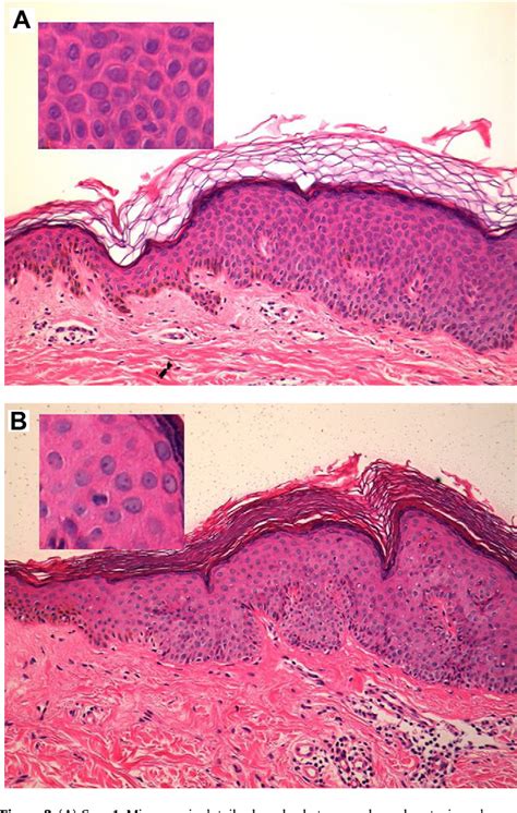 Figure 2 from Large cell acanthoma manifesting as multiple white ...