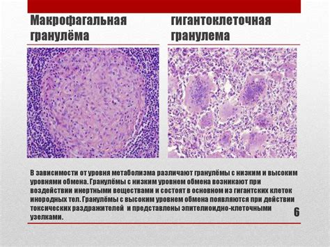 Гранулематозное воспаление - online presentation