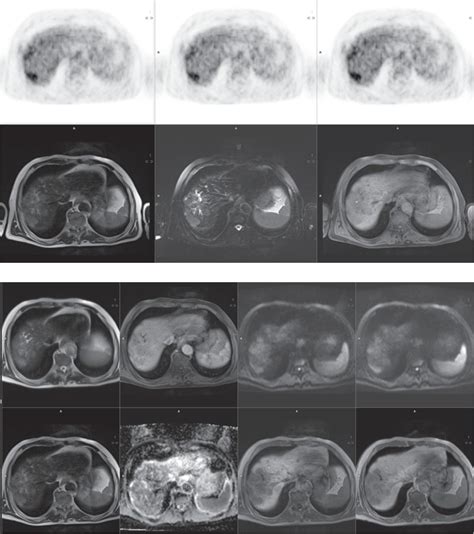 Clinical Application of PET/MRI | Radiology Key