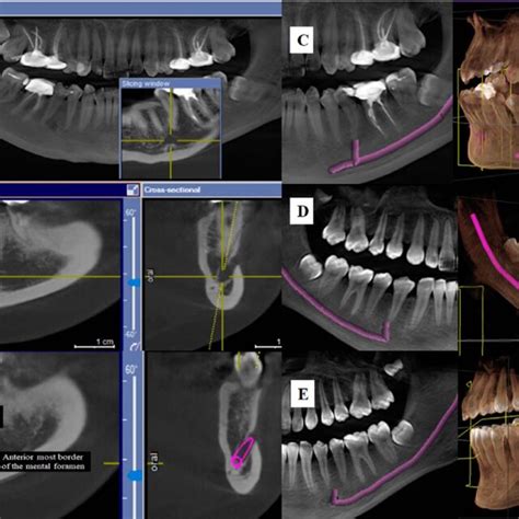 Anterior Loop Of Inferior Alveolar Nerve Download Scientific Diagram