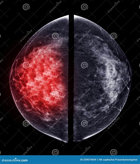 X Ray Digital Mammogram Or Mammography Of Both Side Breast Standard