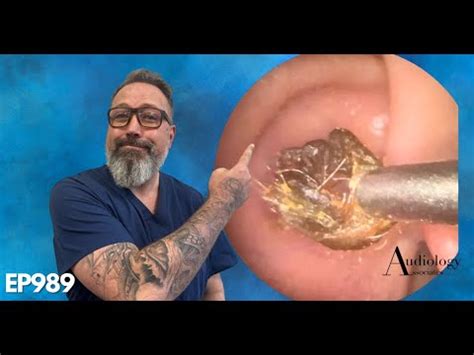 The Most Satisfying Ring Of Dry Ear Wax Removal Ep Youtube