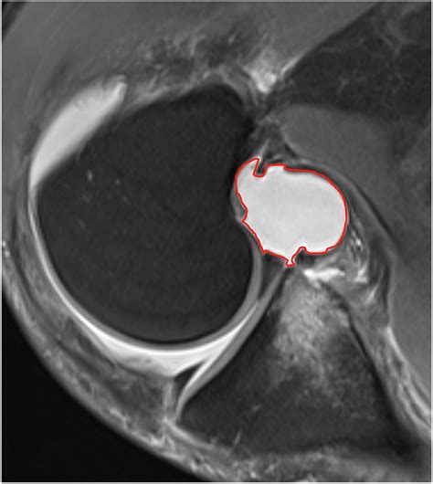 Posterior Displacement Of Meniscal Ramp Lesion Is Observed On Flexed