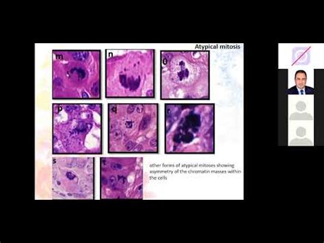 GYNAE PATHOLOGY CASES 4 YouTube