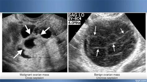 Approach To Ovarian Masses New