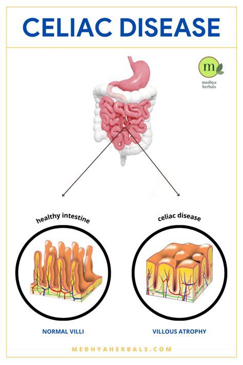 Celiac Disease Treatment An Ayurvedic Doctors Guide