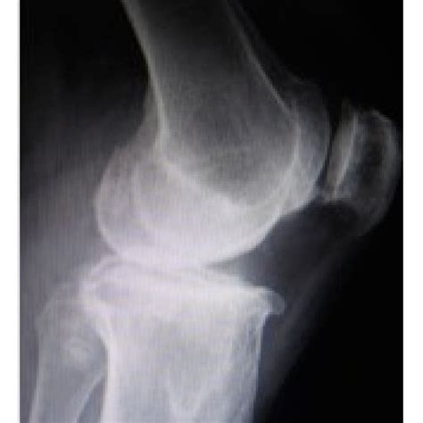 Acceleration Of The Conventional And Bicruciate Stabilized Total Knee