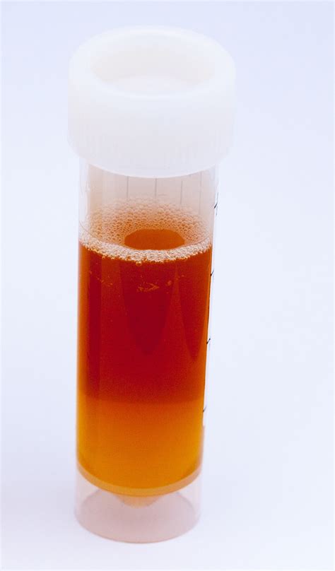 Bloody Urine: Top Causes Including Cancer » Scary Symptoms