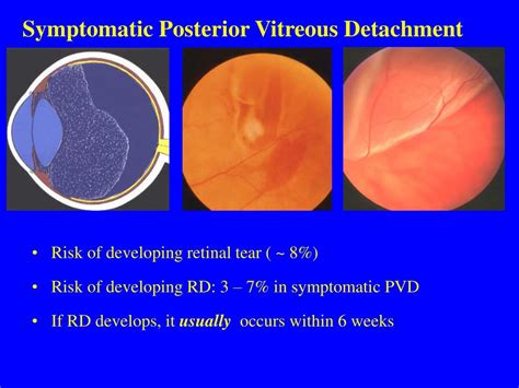 PPT - Flashes and Floaters PowerPoint Presentation - ID:337214