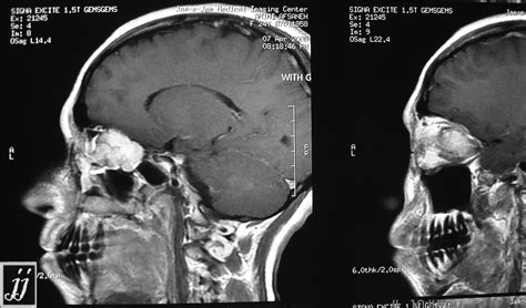 Nasal Tumor Radiopaedia