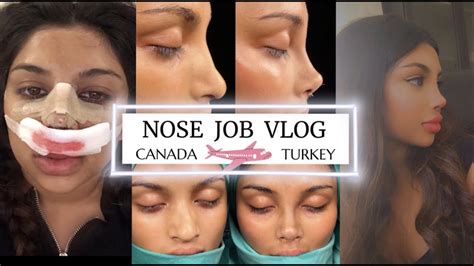 Nose Job Rhinoplasty In Turkey Vlog Dr Resit Burak Kayan Full