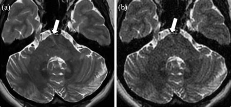 Figure 1 From Thin Slice Two Dimensional T2 Weighted Imaging With Deep