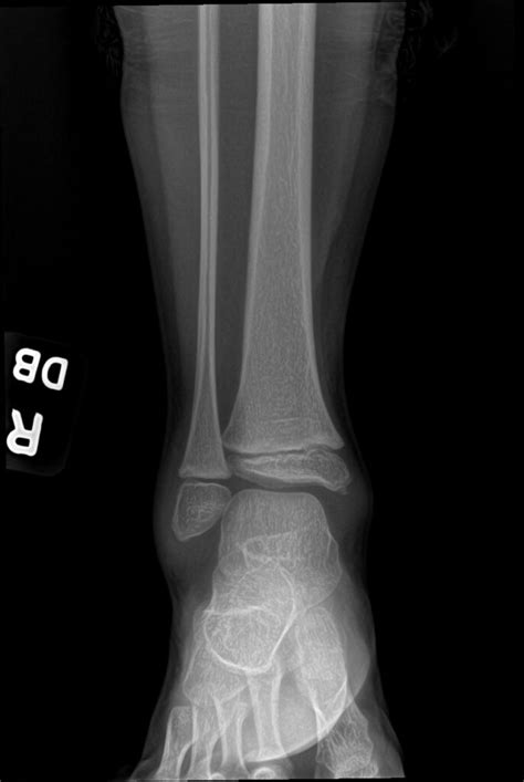 Orthodx Suspected Pediatric Ankle Fracture Clinical Advisor