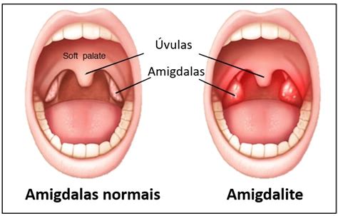 Amigdalite Medicina De Excel Ncia