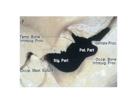 Jugular Foramen Anatomy And Approaches