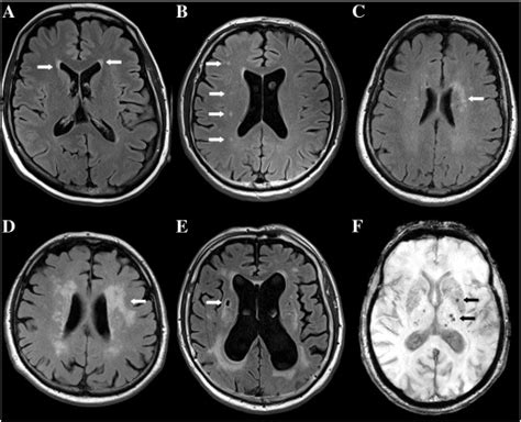 Different Lesion Types Commonly Found On Mri Scans Of Elderly People