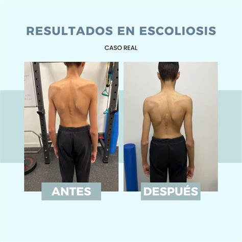 Tratamiento De La Escoliosis En Sevilla Alma Salud