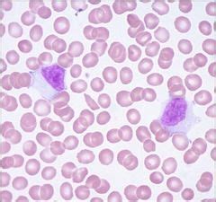 Atypical Lymphocytes