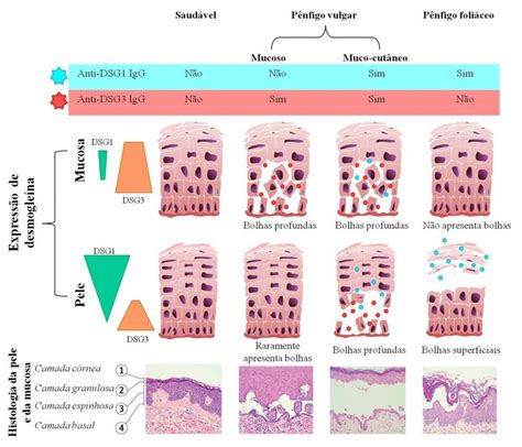 Pênfigo Vulgar Patologia Bucal