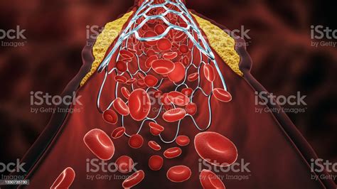 Angioplasty 3d Rendering Illustration Deployed Stent Within A Diseased