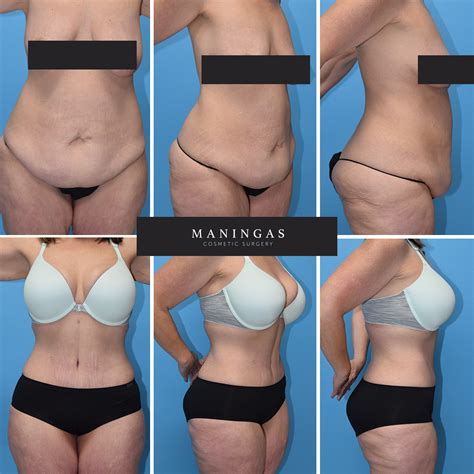 Tummy Tuck With Core Liposuction Results Maningas Cosmetic Surgery