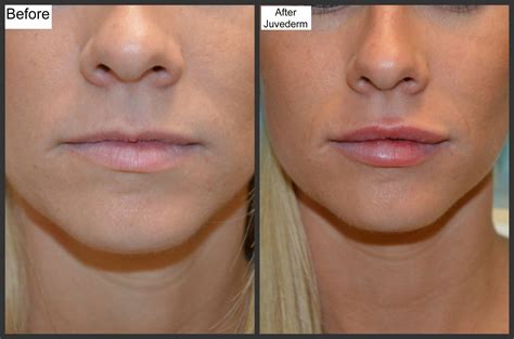 Before And After Photos Millefiori Dermal Fillers Restylane Lips