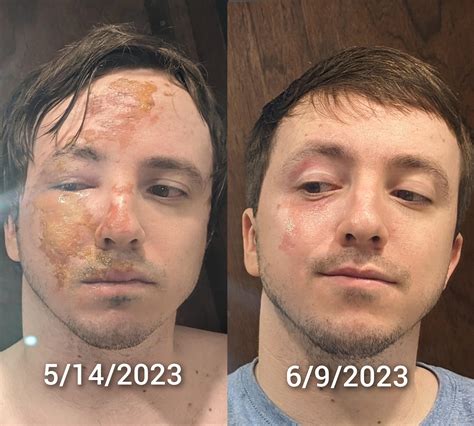 [beforeandafter] Faceplanted In A Fire Pit About A Month Ago Wanted To