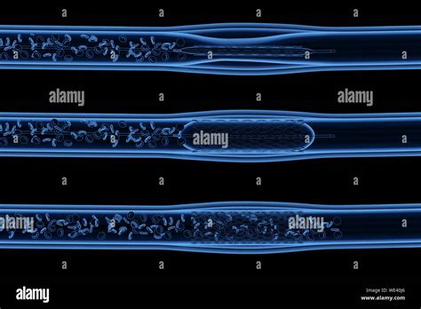 3d Rendering X Ray Balloon Angioplasty Procedure With Stent In Vein