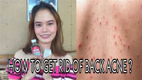 How To Get Rid Of Back Acne And Pimples Youtube