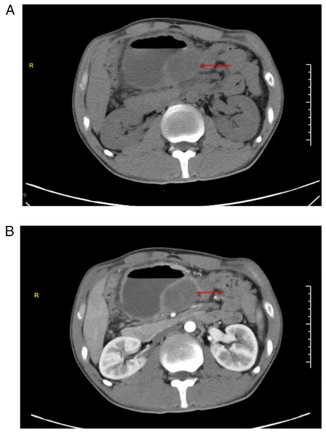 Primary Intraabdominal Desmoid Fibromatosis Associated With Familial