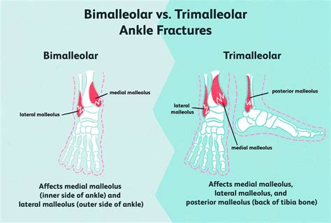 Bimalleolar Fracture Broken Ankle Causes Symptoms 49 Off