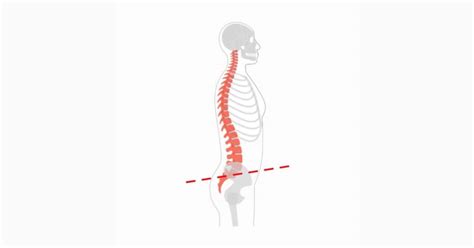 Posture Correction Strategies For Posterior Pelvic Tilt Dr Body Gadget