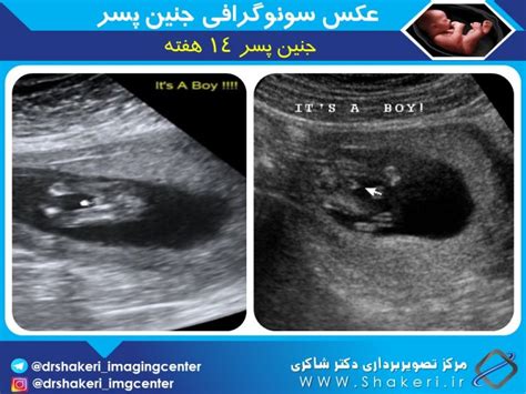 عکس سونوگرافی جنین پسر مرکز تصویربرداری دکتر شاکری