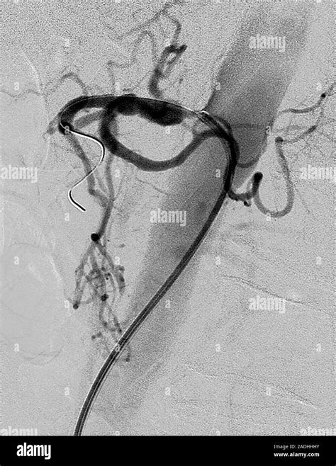 Angioplastia Con Bal N Rayos X De Un Cat Ter De Bal N Se Colocan En El