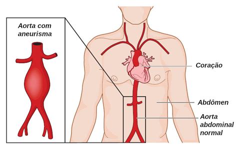 O Que É Um Aneurisma O Que E Aneurisma Sintomas Tipos Causas E