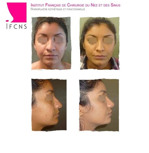 Rhinoplastie avant et après opération à Paris Institut Rhinoplastie