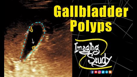 Gallbladder Polyps Ultrasound Case 335 Youtube