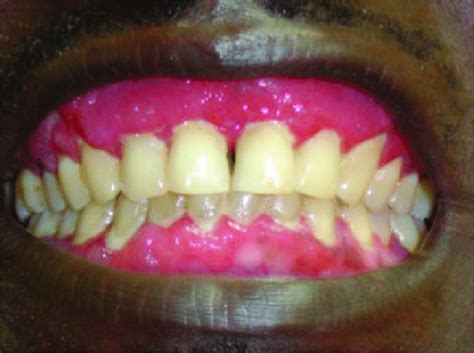 The Granular Erythematous Appearance Of Patient S Gingival This