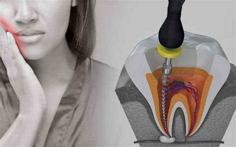 Root Canal Therapy Procedure Of Root Canal Therapy