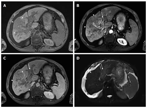 Liver Cirrhosis MRI